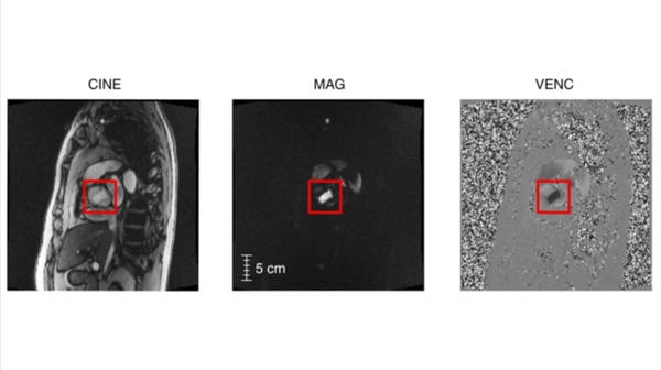 Uncropped MRI frames for CINE, MAG, and VENC series in an oblique coronal view of the thorax